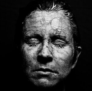 デリケートゾーンの乾燥と黒ずみの関係は何か？